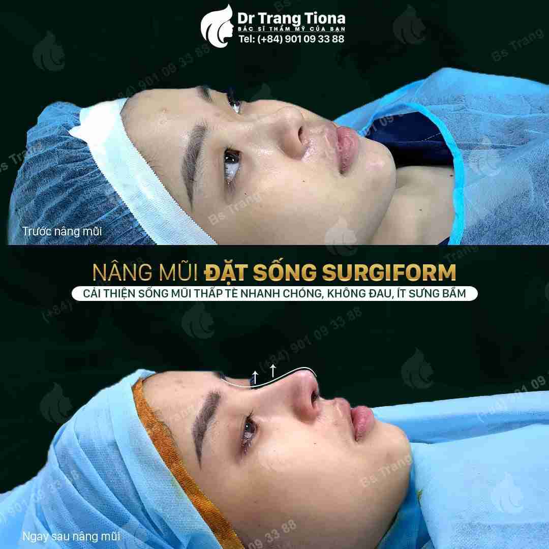 Bác sĩ giải đáp: Nâng mũi Surgiform giữ được bao lâu?