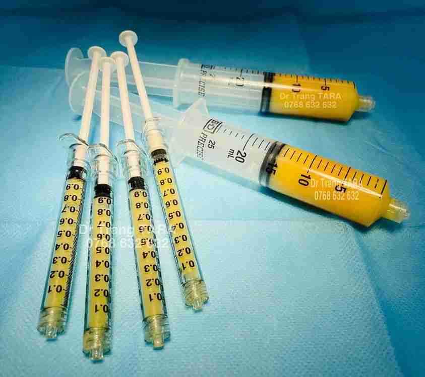 Nên tiêm filler hay cấy mỡ rãnh cười thì tốt nhất?