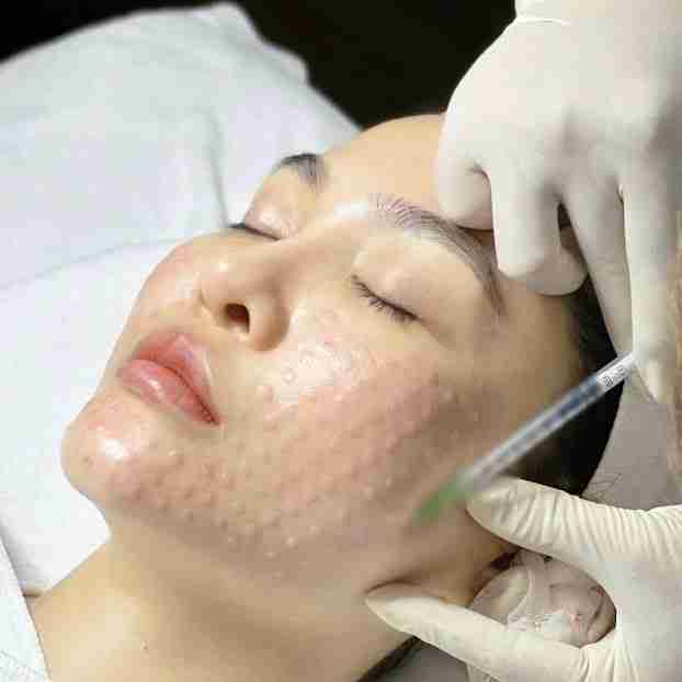 Cẩm nang hữu ích tiêm căng bóng da mà bạn cần biết