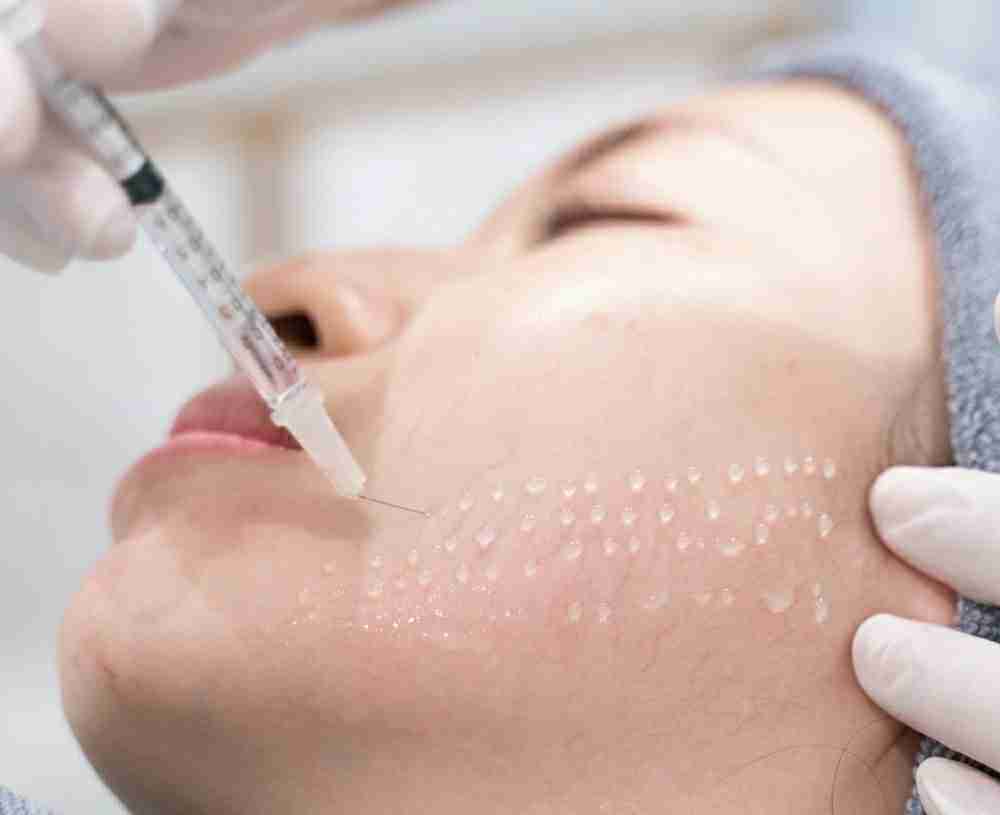 Cẩm nang hữu ích tiêm căng bóng da mà bạn cần biết