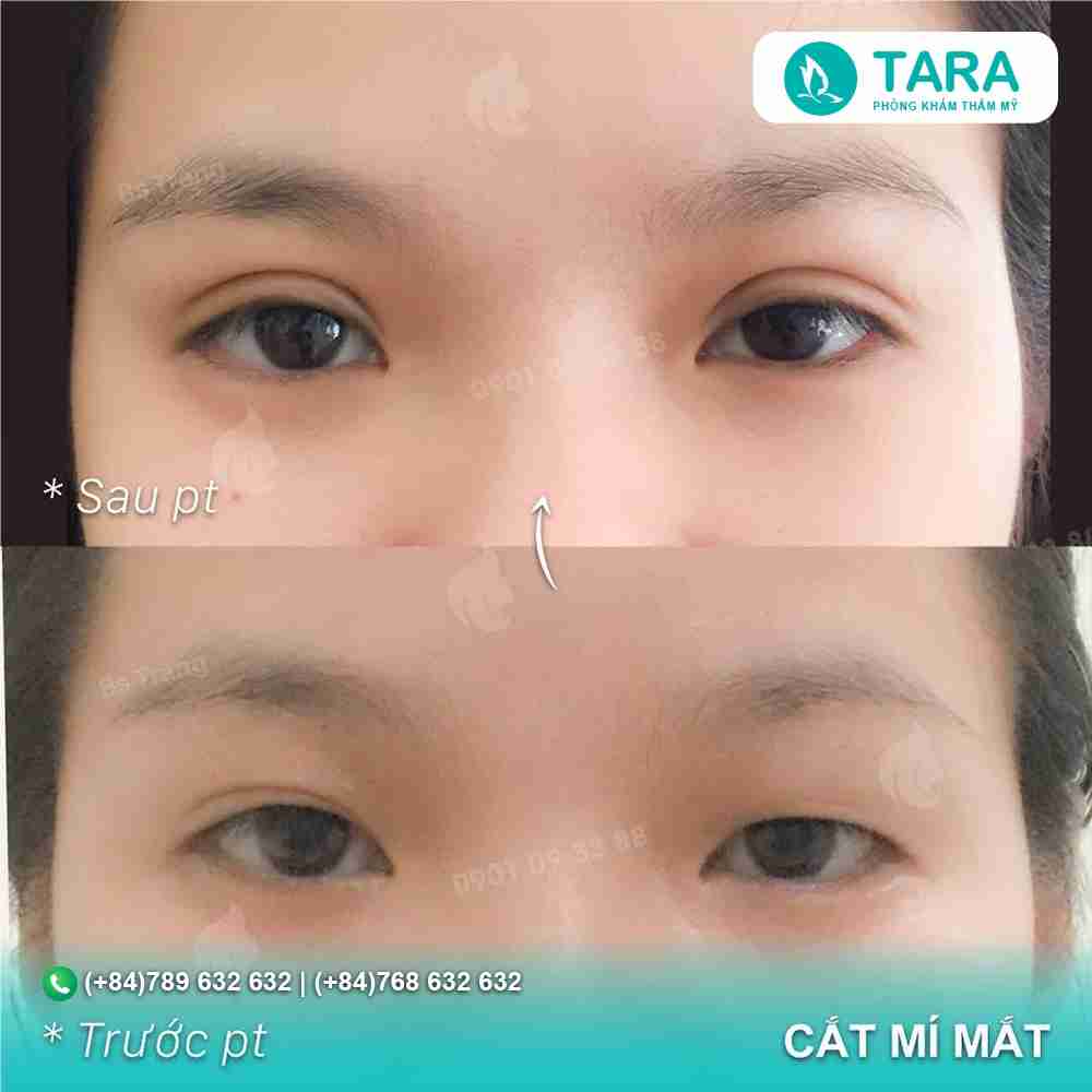 Sự thật việc cắt mí mắt để được vĩnh viễn 