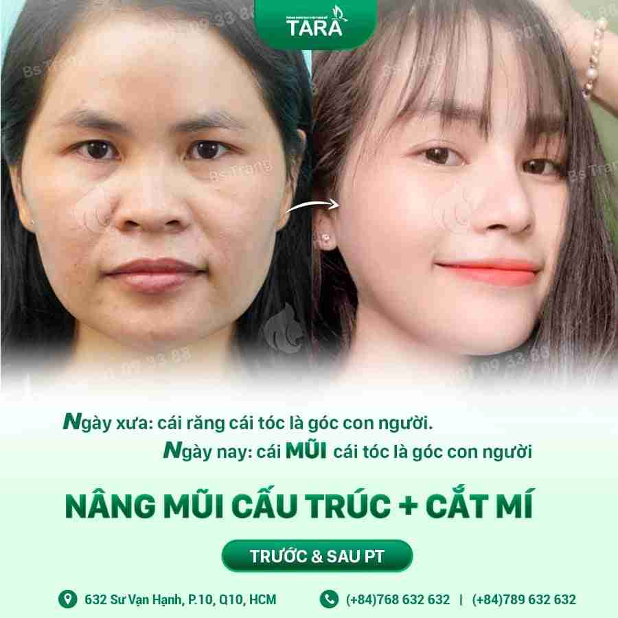 Bác sĩ giải đáp: Cắt mí mắt có đau không?