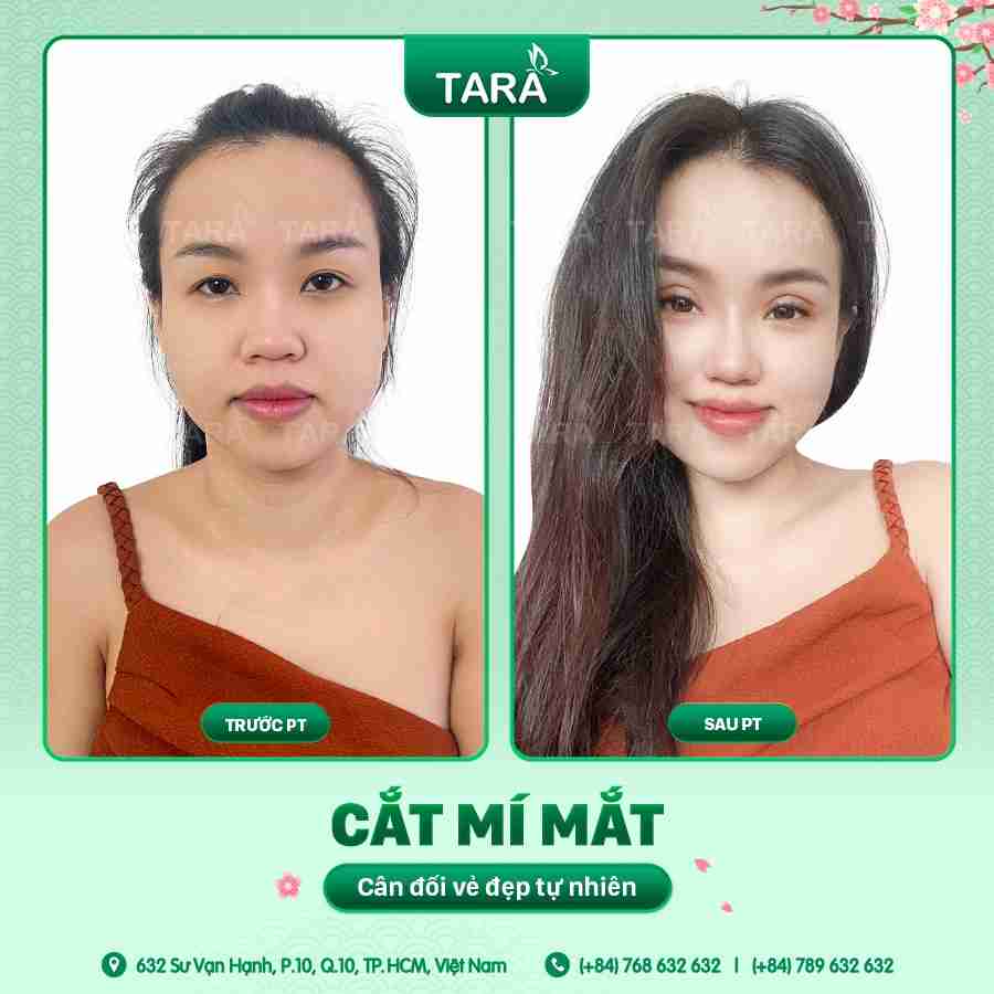 Bác sĩ giải đáp: Cắt mí mắt có đau không?