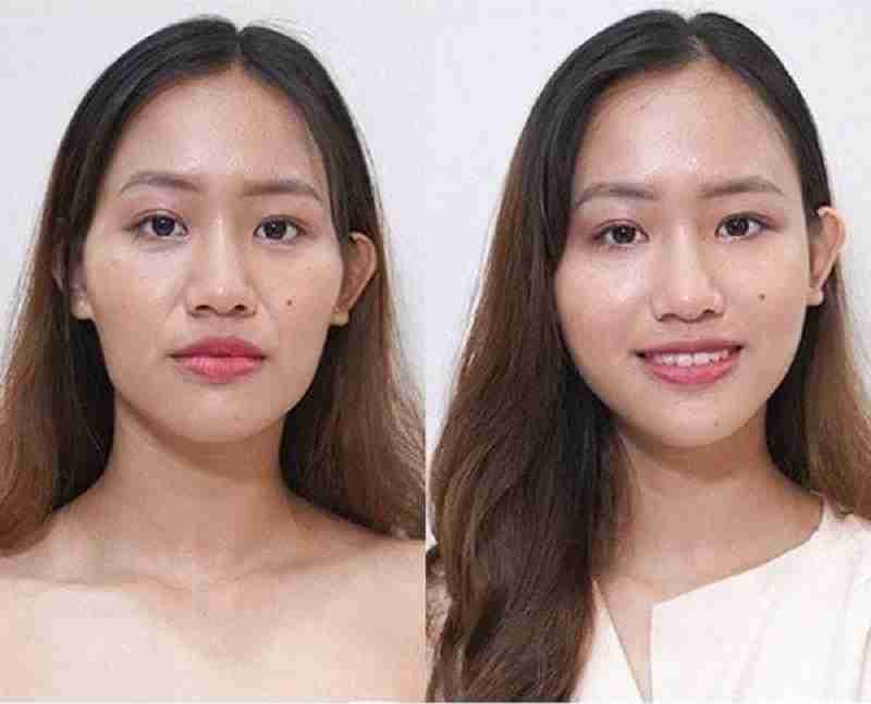 Có nên tiêm filler thái dương không?