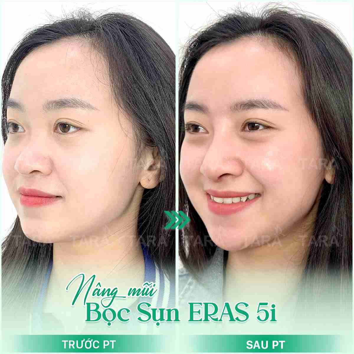 Thẩm mỹ mũi