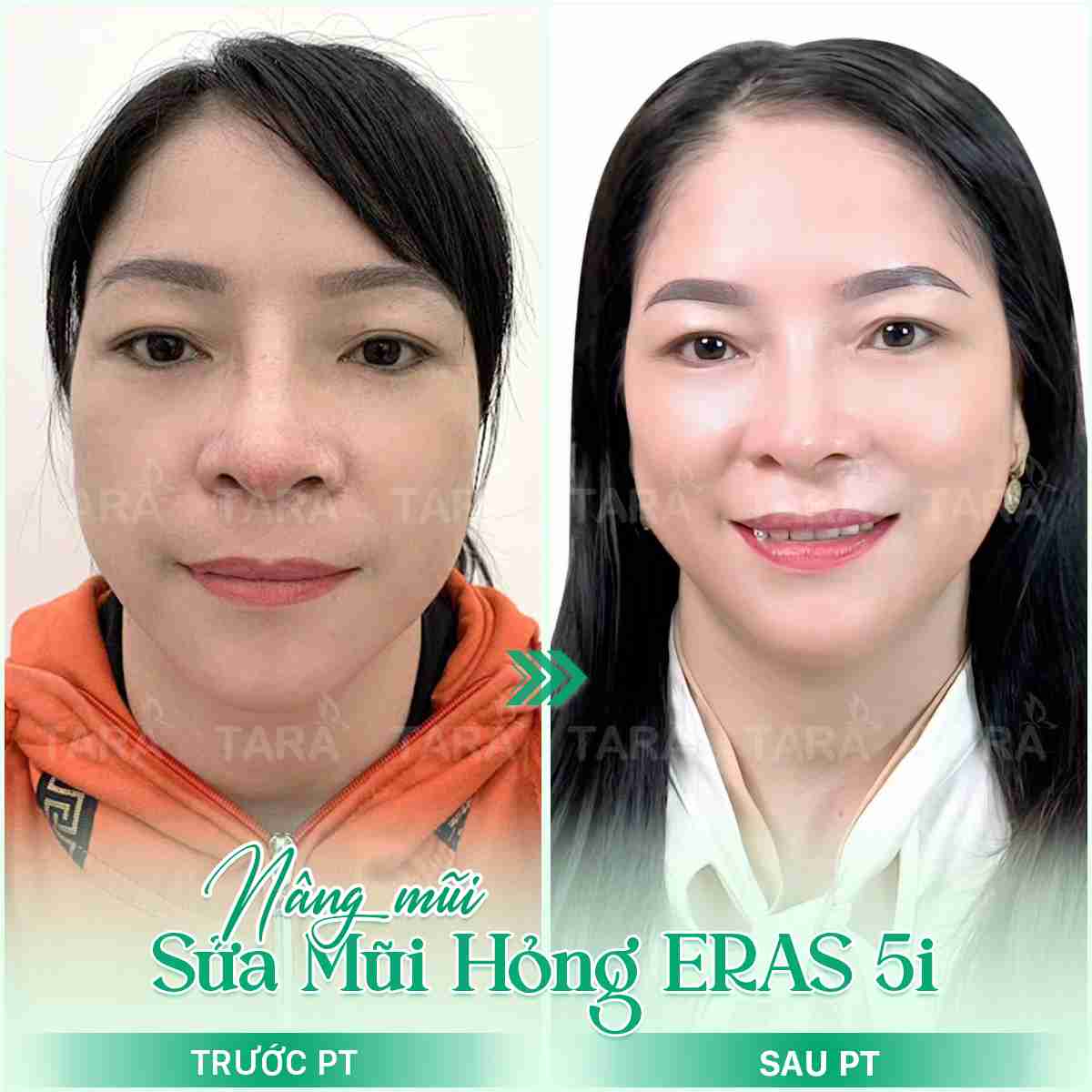 Nâng mũi sụn sườn ERAS 5i