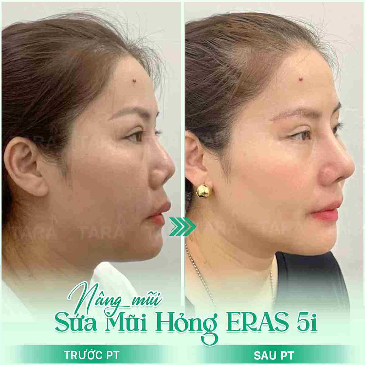 Nâng mũi sụn sườn ERAS 5i