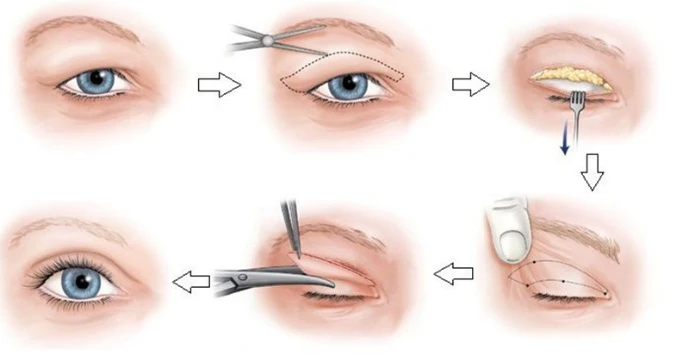 Cắt mí giá bao nhiêu? 5 triệu có đủ để cắt mí không?