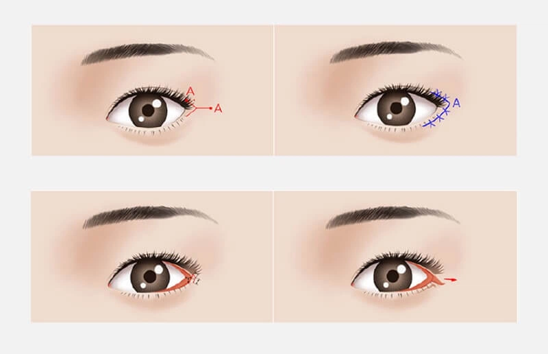 Cắt mở góc mắt là gì, thực hiện như thế nào?