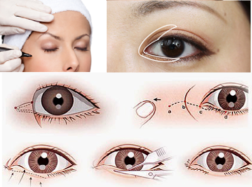 Cắt mở góc mắt là gì, thực hiện như thế nào?