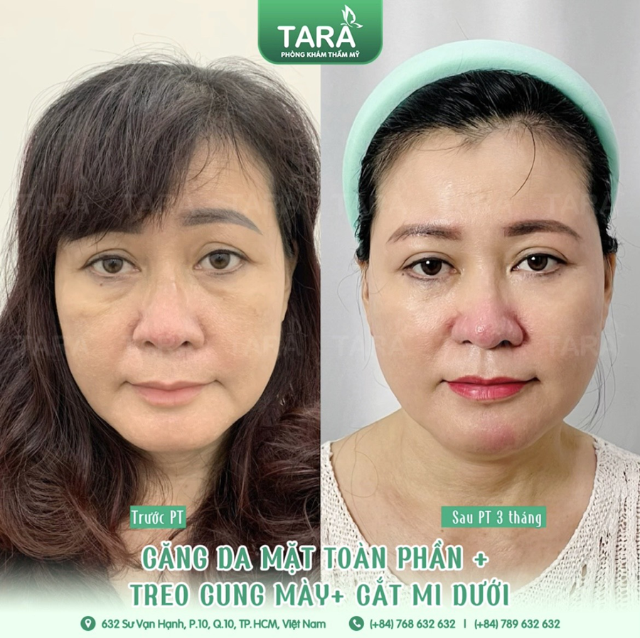 Trước khi căng da mặt cần biết 12 điều này