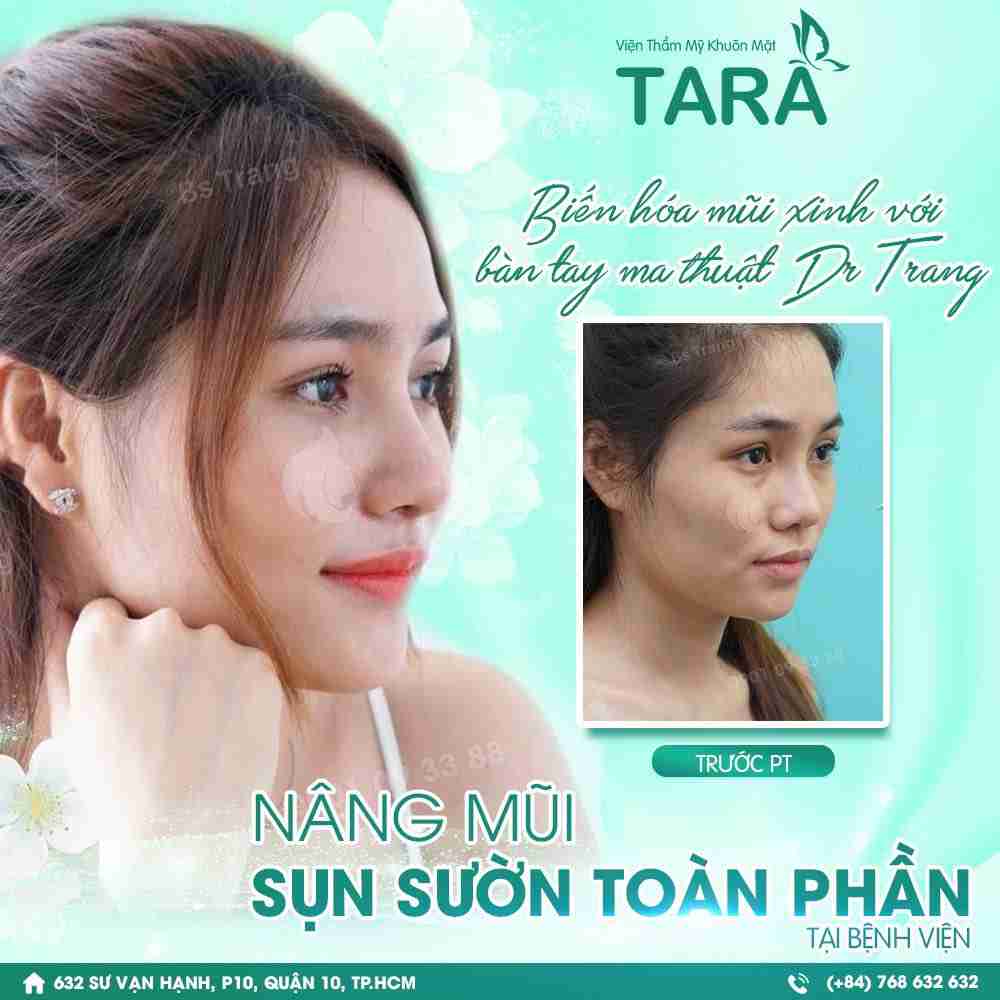 Nâng mũi sụn sườn ERAS 5i