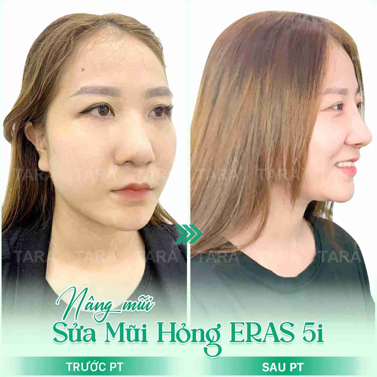 Thẩm mỹ mũi