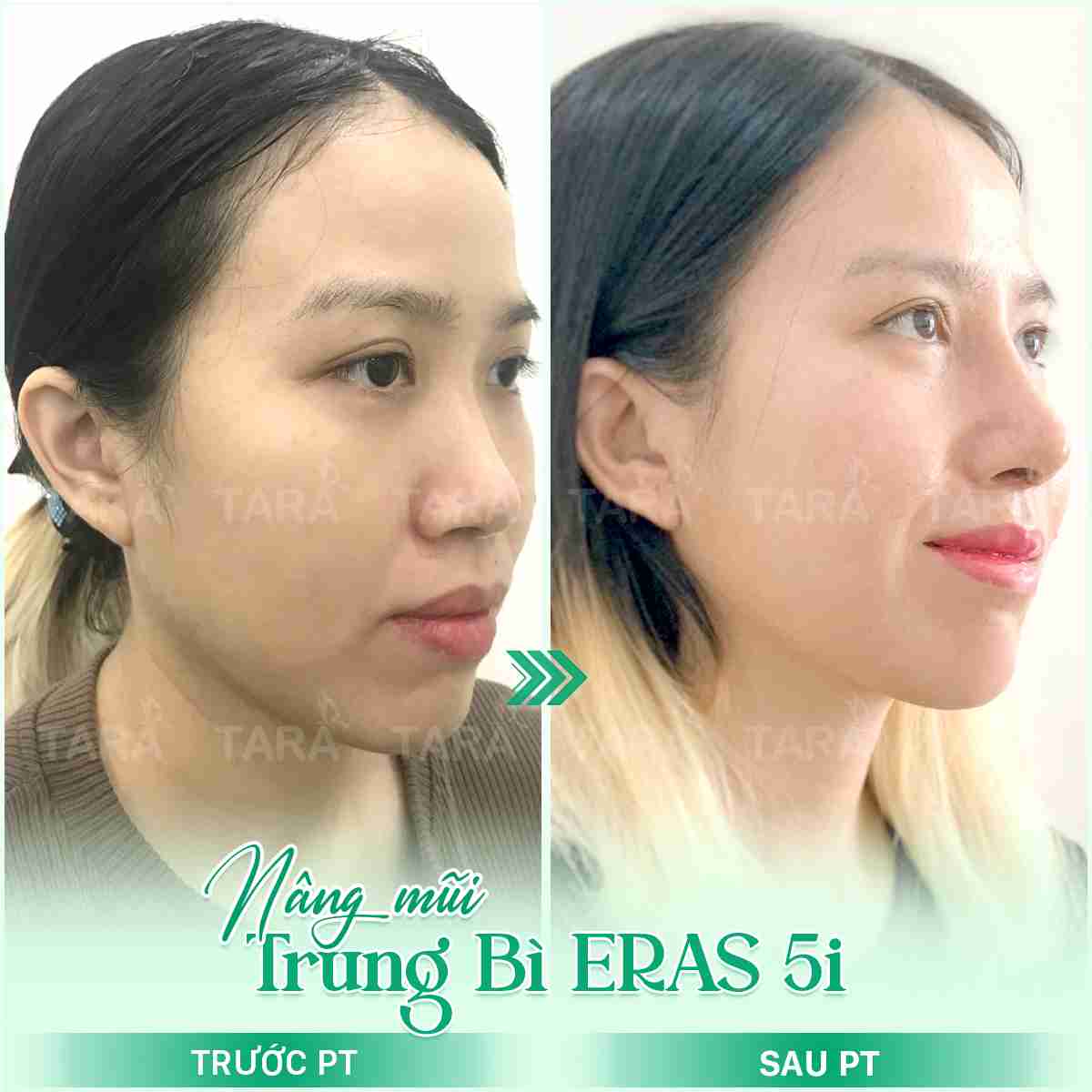 giá sửa mũi hỏng