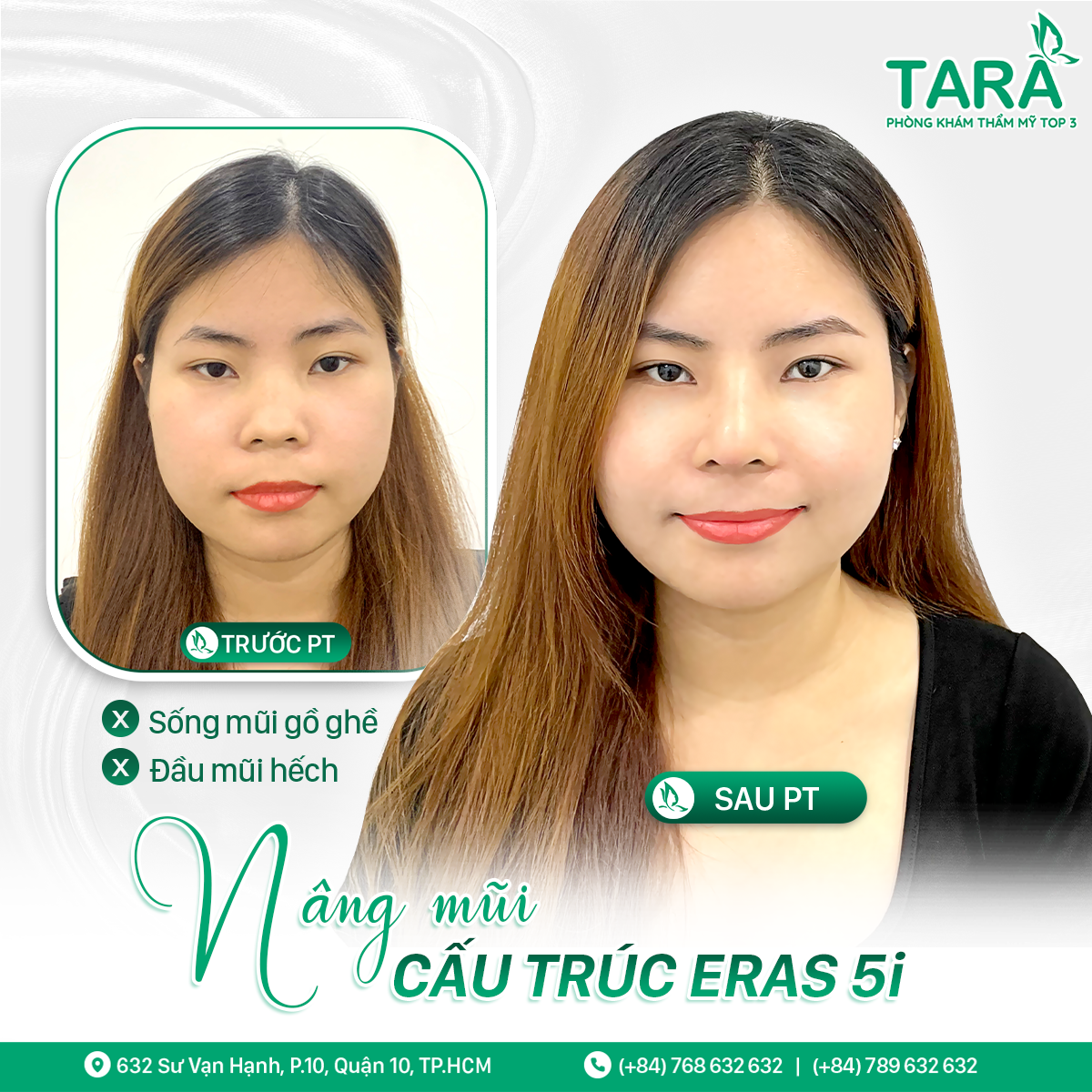 nâng mũi sụn tự thân nâng mũi sụn tự thân