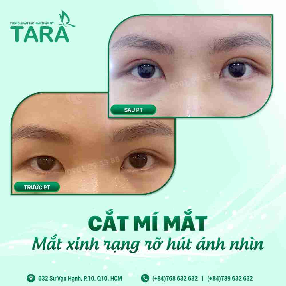 Cắt mí mắt ở đâu thì đẹp?