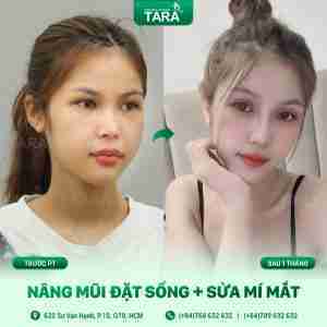 nâng mũi cấu trúc nâng mũi cấu trúc