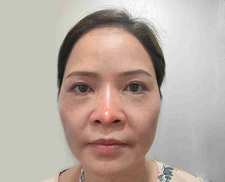 5 nguyên nhân gây mũi lộ sống? Làm sao để khắc phục?