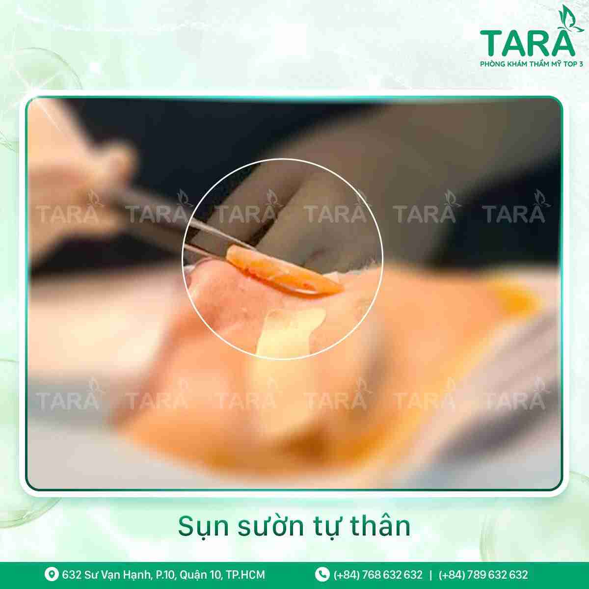 Nâng mũi sụn tự thân hay sụn nhân tạo thì đẹp nhất?
