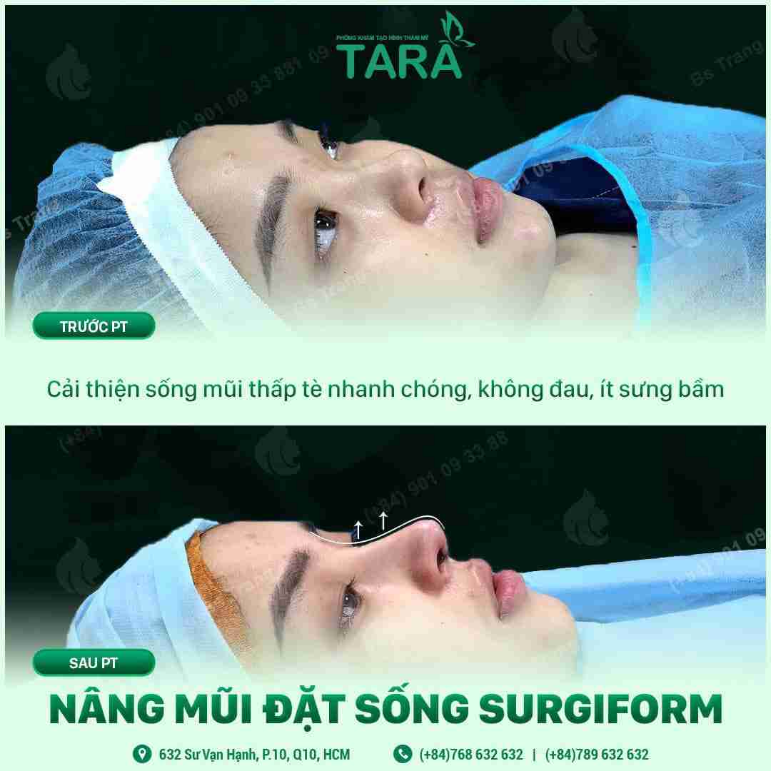 Nâng mũi sụn tự thân hay sụn nhân tạo thì đẹp nhất?