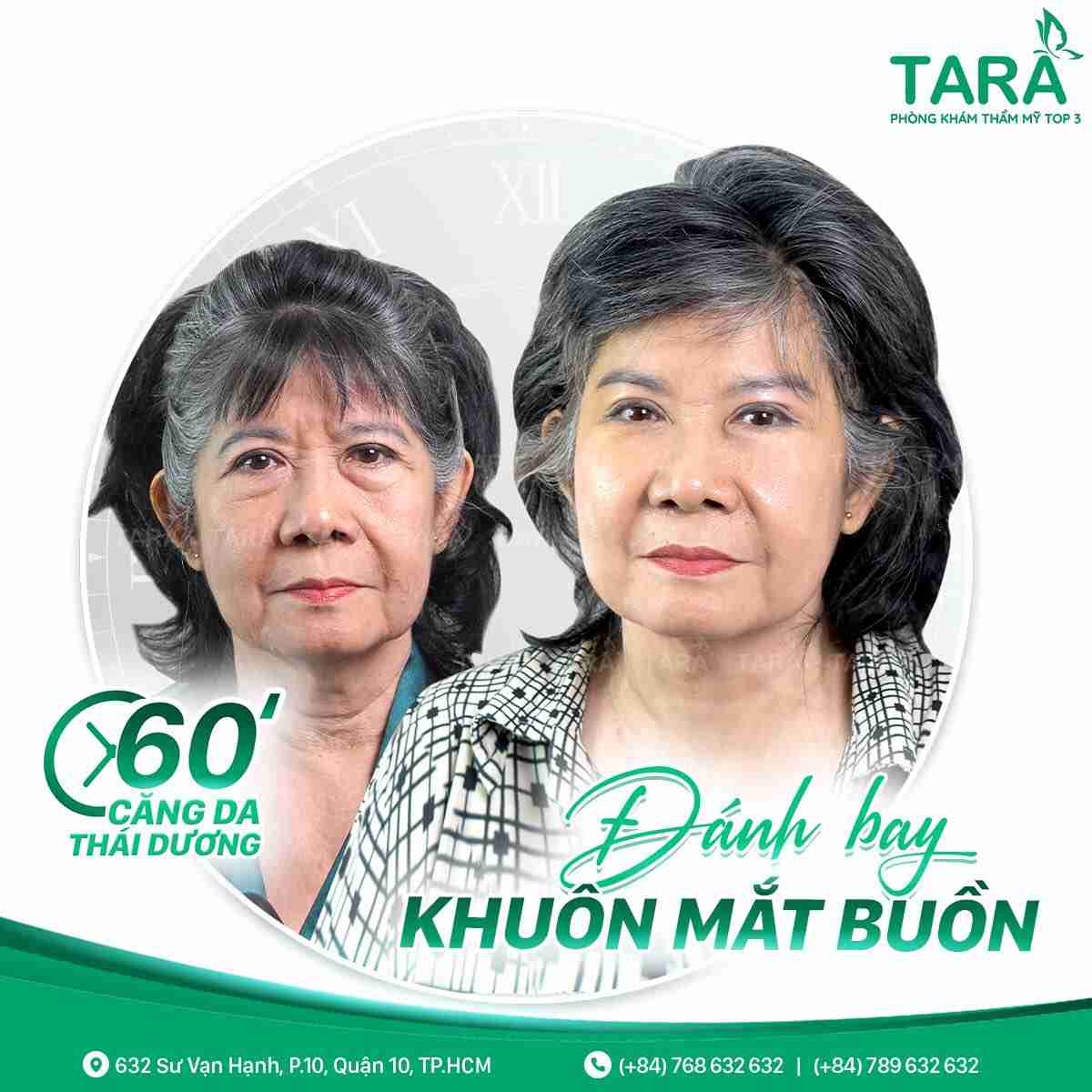 phẫu thuật căng da mặt