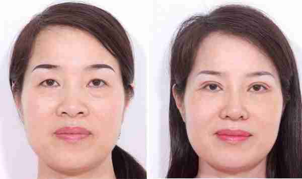 Top 5 địa chỉ lấy bọng mỡ mắt uy tín tại TPHCM