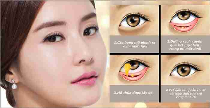 Top 5 địa chỉ lấy bọng mỡ mắt uy tín tại TPHCM