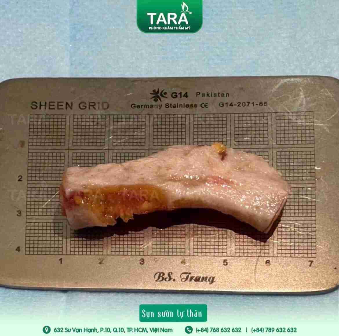 Tư vấn nâng mũi sụn tự thân cho da mũi mỏng
