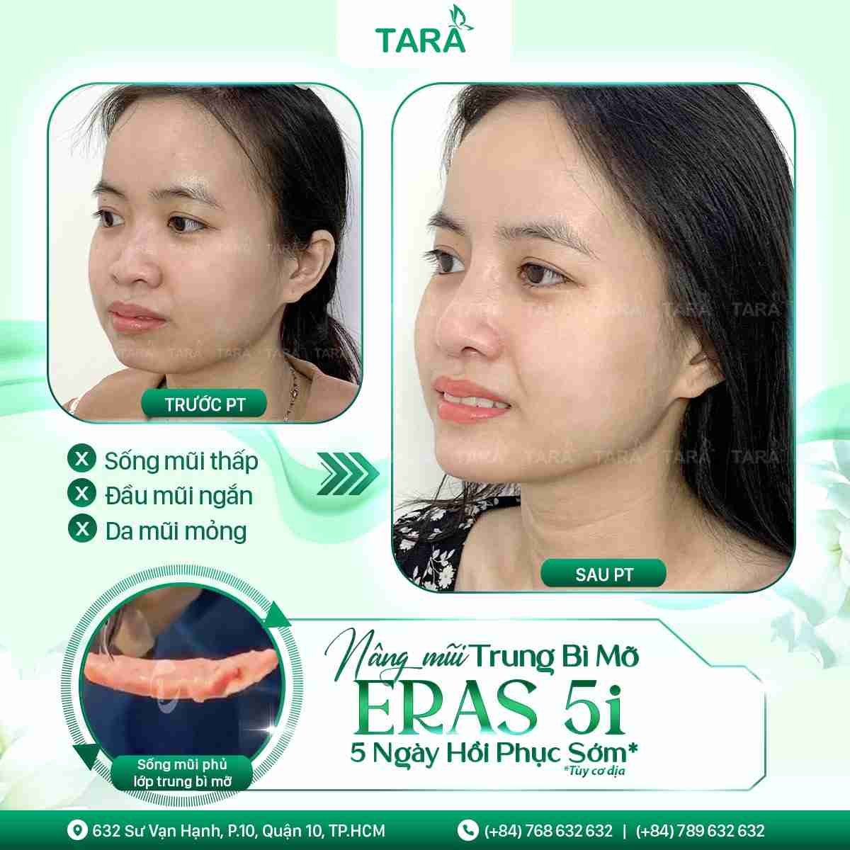 Tư vấn nâng mũi sụn tự thân cho da mũi mỏng
