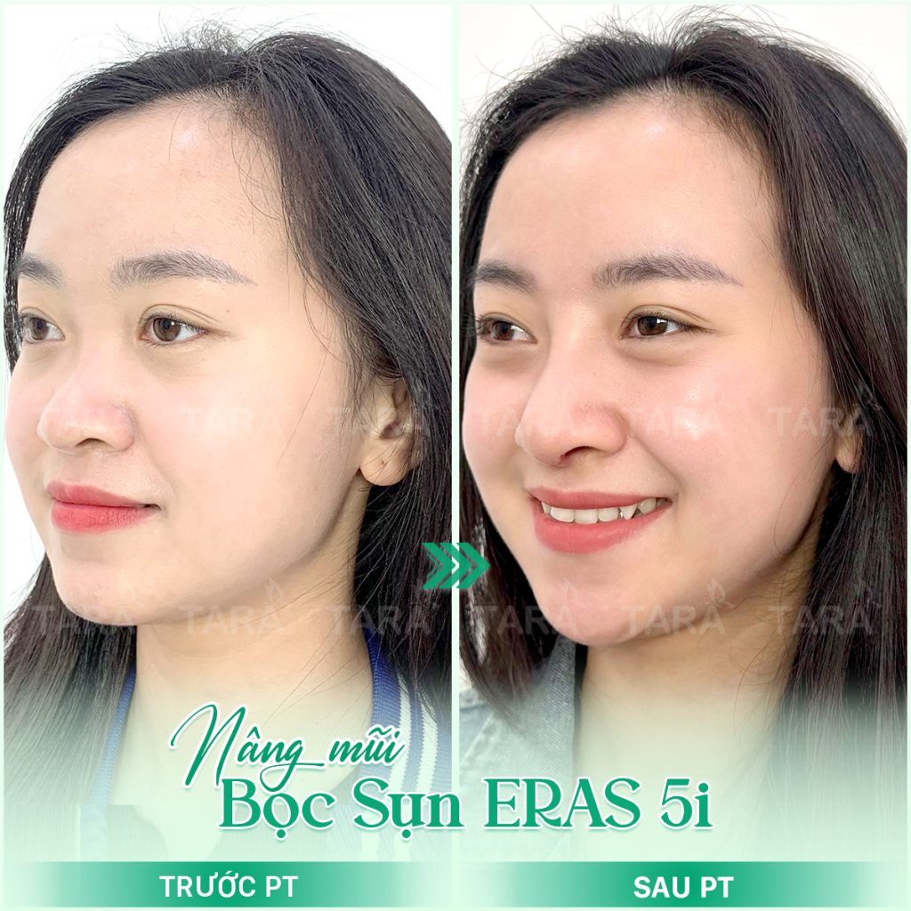 Bác sĩ nâng mũi giỏi tphcm Bác sĩ nâng mũi giỏi tphcm