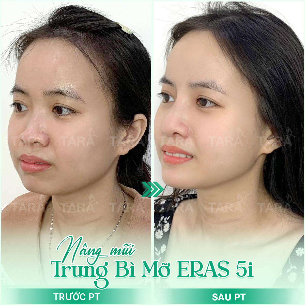 Địa chỉ nâng mũi uy tín