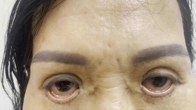 Tại TPHCM, sửa mí hỏng ở đâu thì đẹp?
