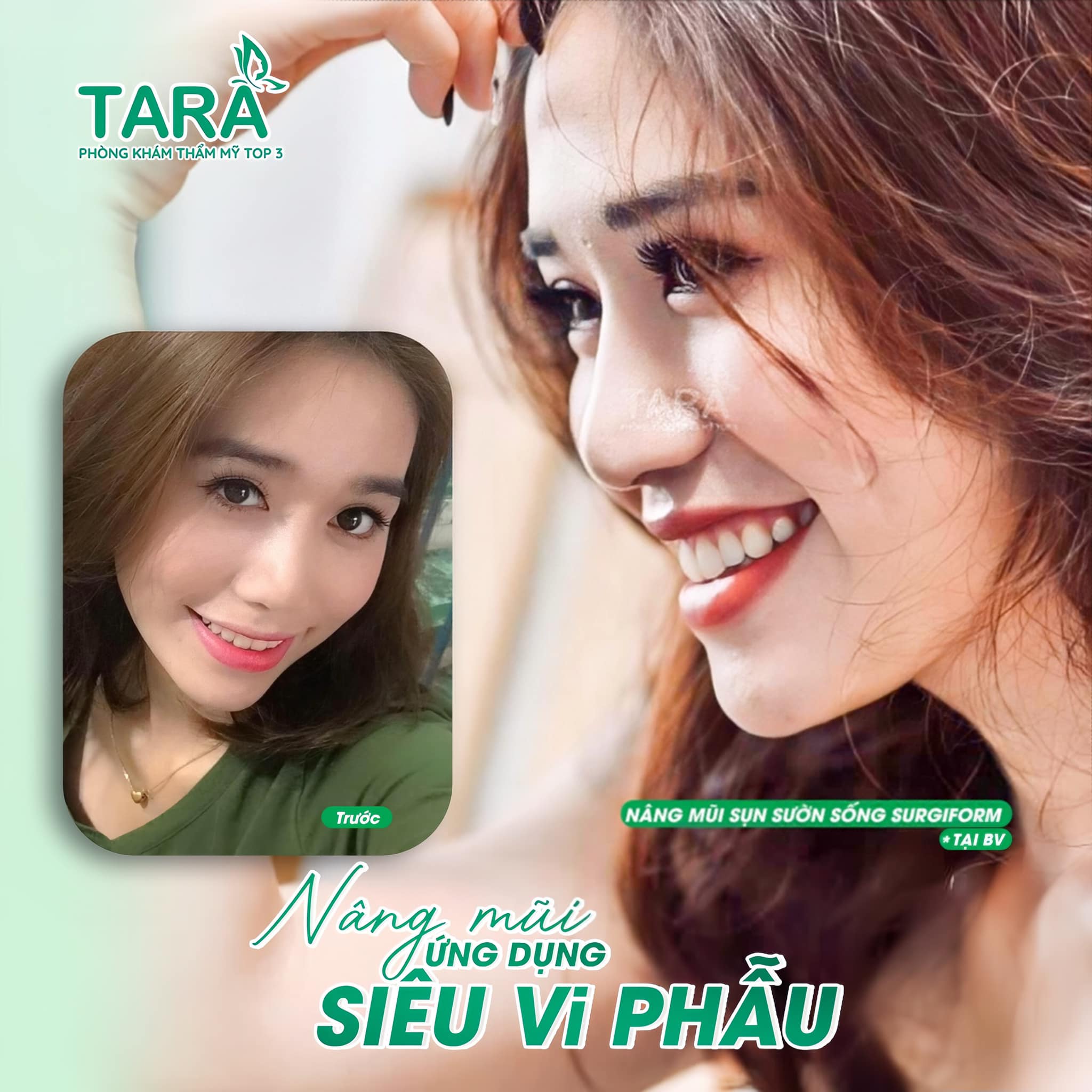 nâng mũi siêu vi phẫu