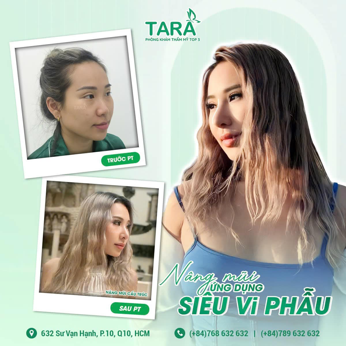 5 cái nhất về nâng mũi siêu vi phẫu chỉ có tại TARA