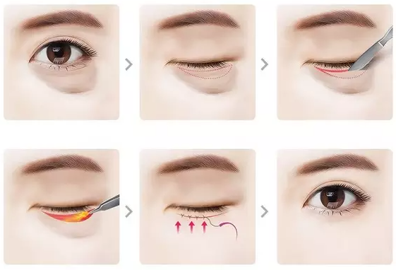 4 điều cần biết trước khi lấy bọng mỡ mắt 