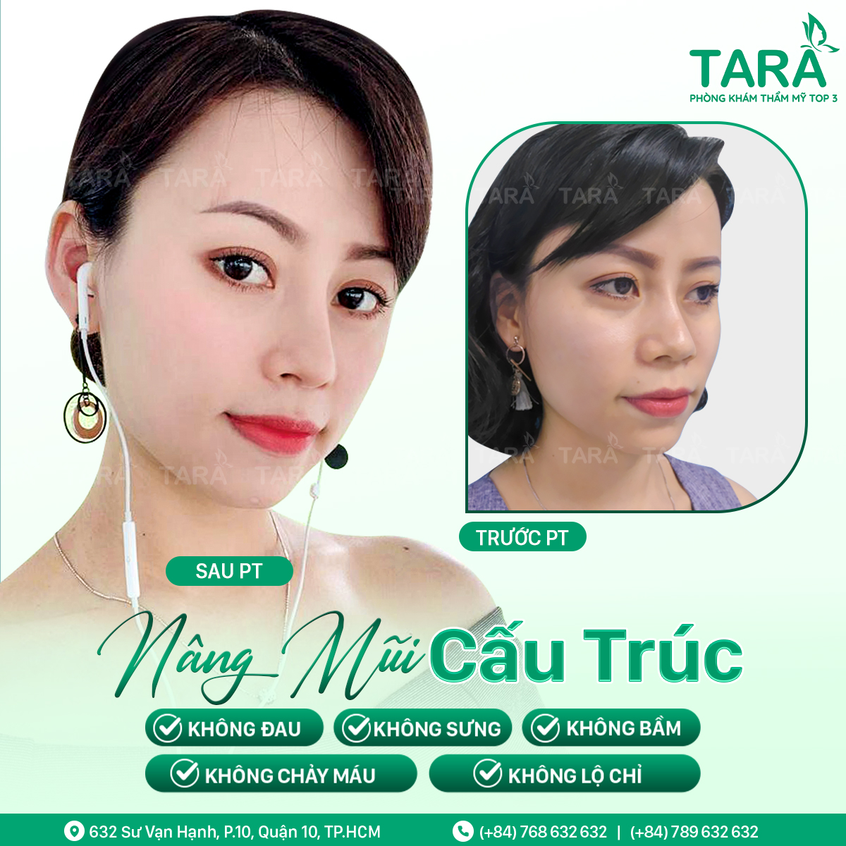 Bị viêm xoang mũi dị ứng nâng mũi 