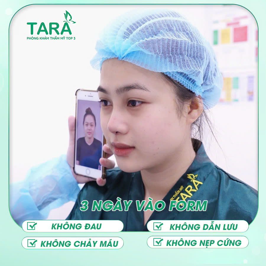 Nâng mũi siêu vi phẫu không đau bằng sụn tự thân