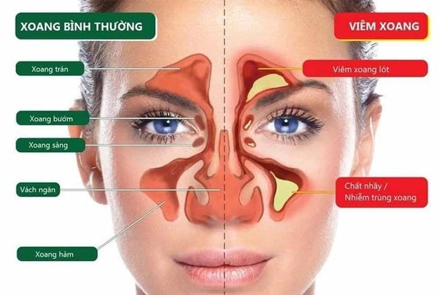 Bị viêm xoang mũi dị ứng nâng mũi 