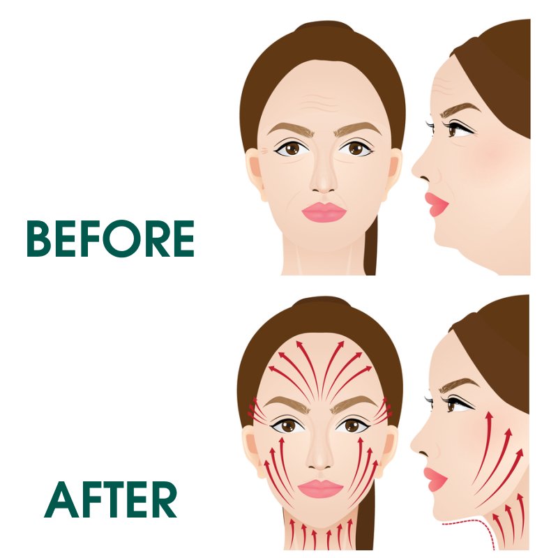 Căng da mặt toàn phần giúp trẻ hoá những phần nào?