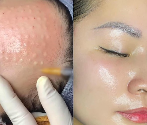 Review tiêm căng bóng: Kinh nghiệm của khách hàng 