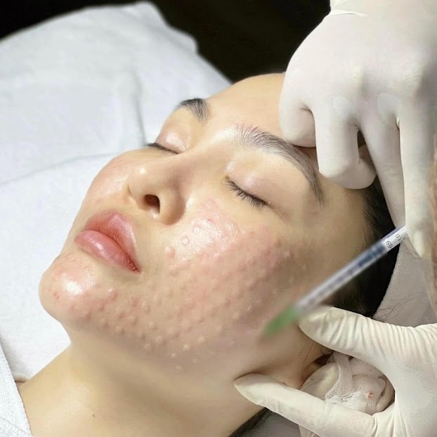 Review tiêm căng bóng: Kinh nghiệm của khách hàng 