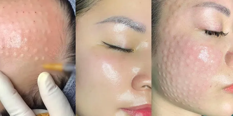 Tiêm căng bóng: Bí quyết sở hữu làn da căng mọng