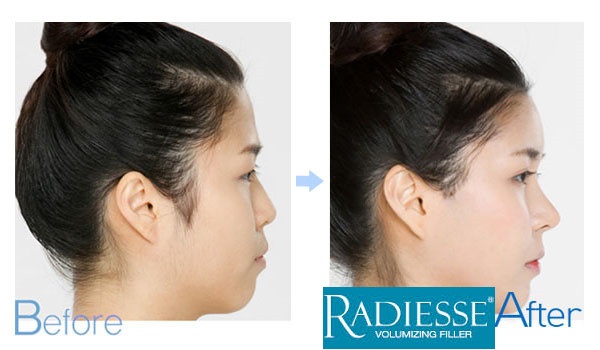 Tiêm Radiesse trẻ hoá da uy tín tại Sài Gòn