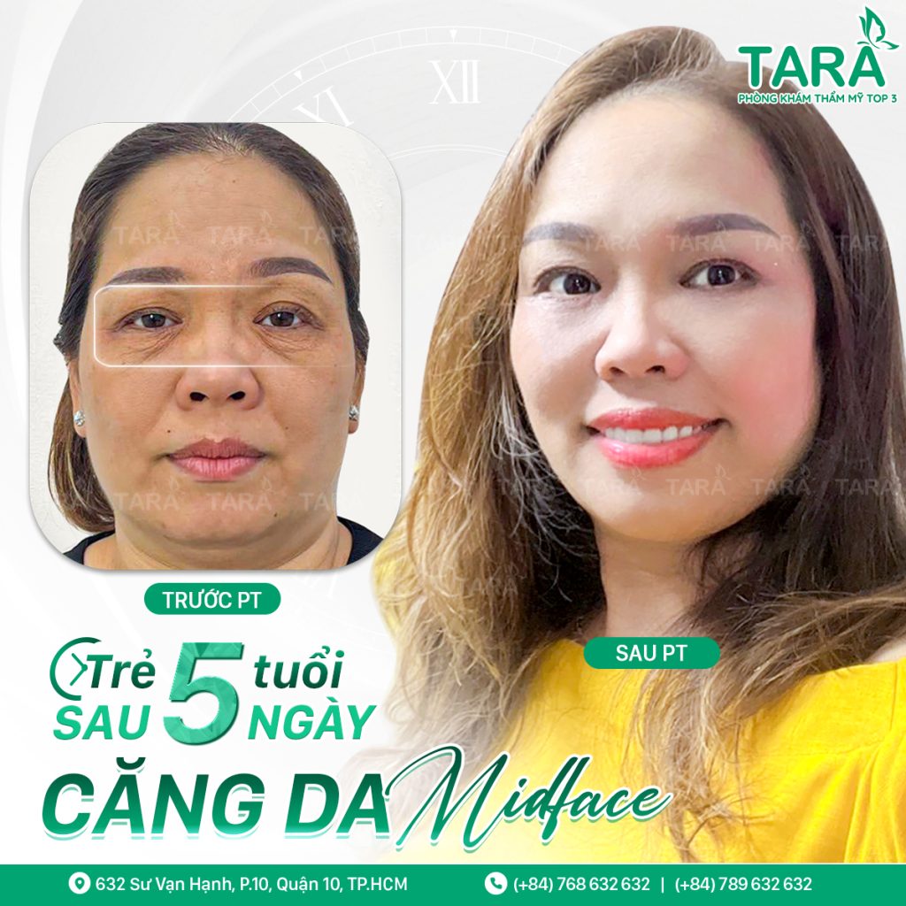 căng da midface xong đi máy bay được không