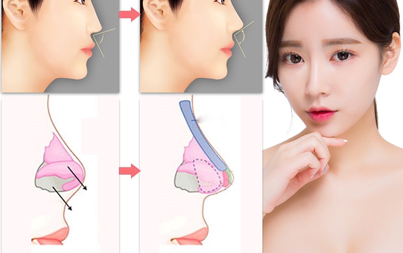 Xoá nỗi sợ nhờ phương pháp nâng mũi không đau hoàn toàn mới