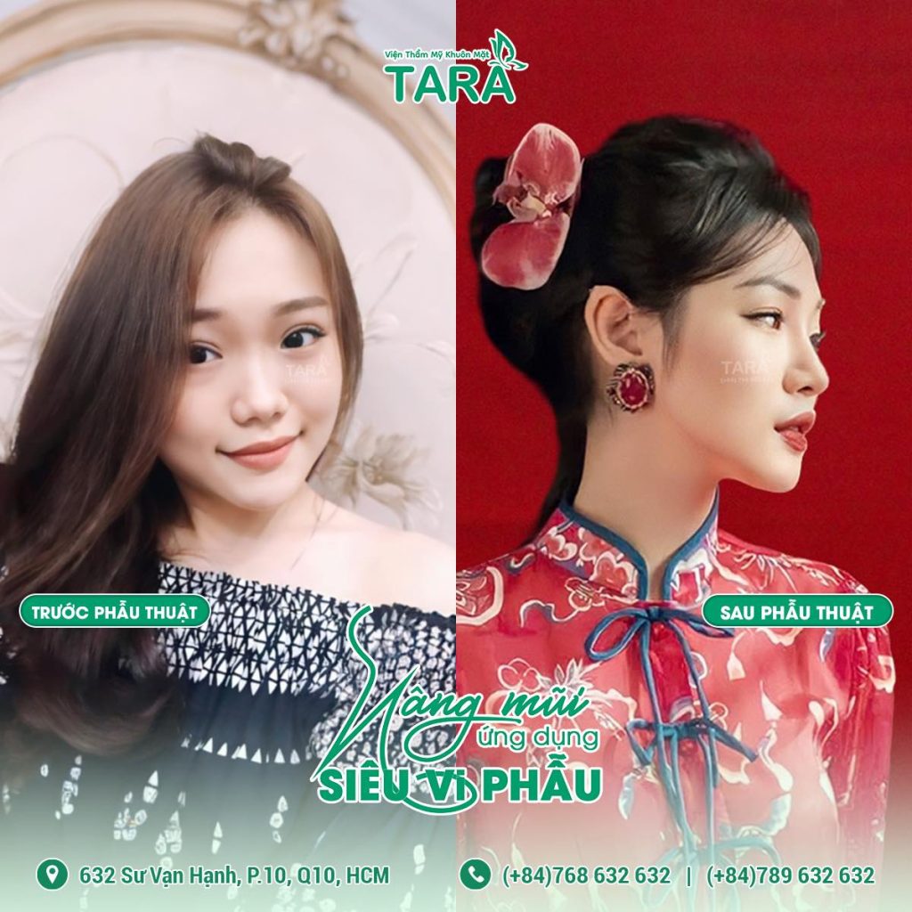 8 lý do nên chọn nâng mũi siêu vi phẫu tại TARA
