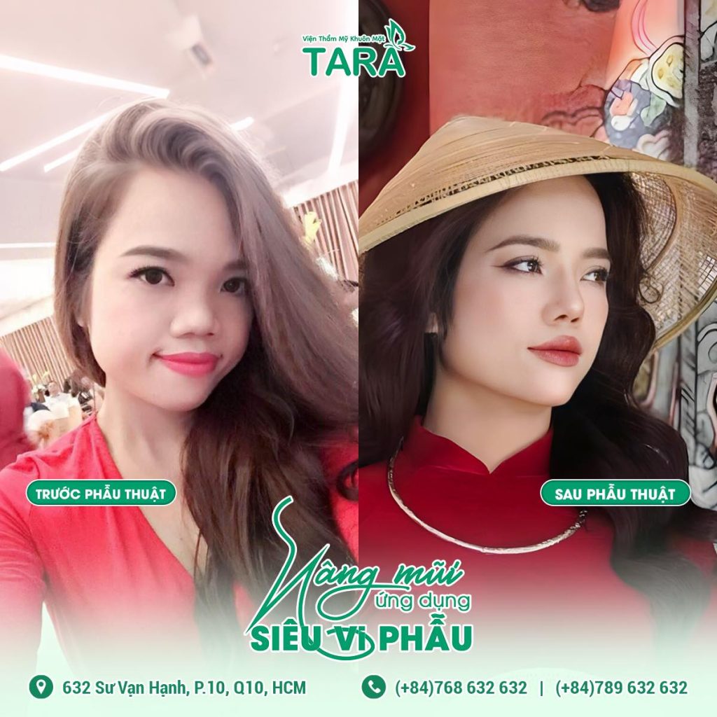 Nâng mũi xong ăn bánh chưng được không?