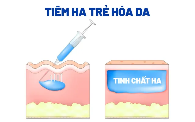 HA là gì? Cơ chế của HA trong cấp ẩm và tiêm trẻ hóa tạo hình khuôn mặt