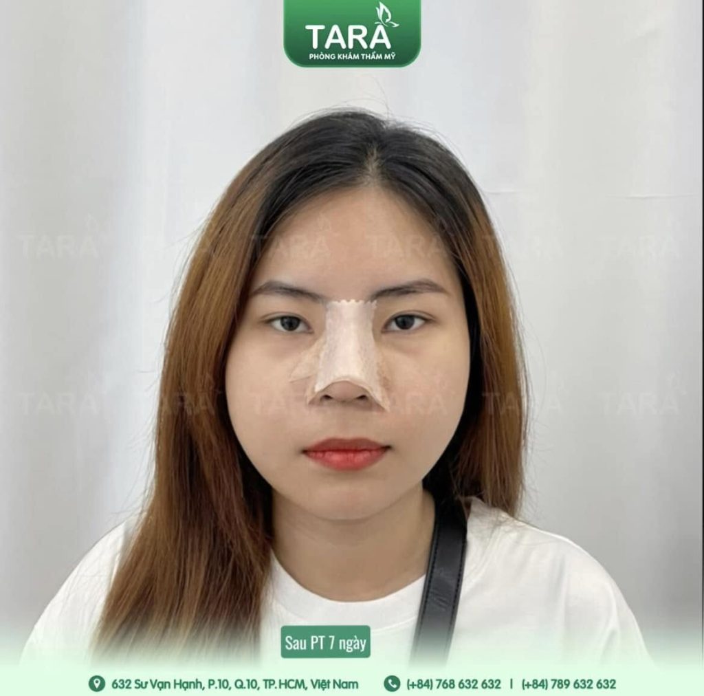 Nâng mũi không nẹp cứng có sao không?
