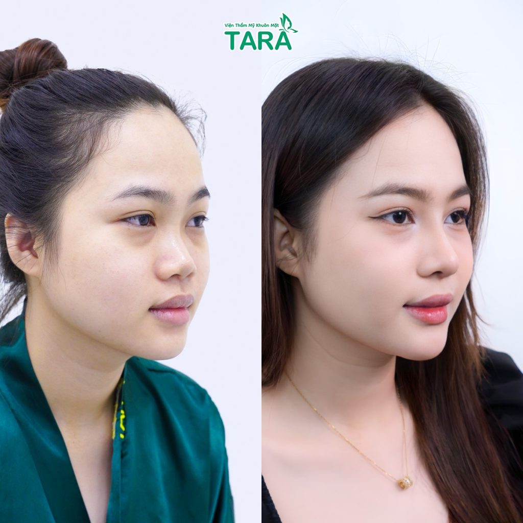 TS.BS Trang: "Không phải cứ nâng mũi cao là đẹp"